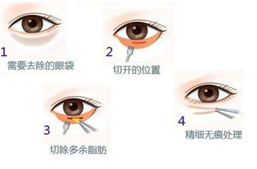 上海纽菲思医疗美容门诊部去眼袋好吗？优势阐述