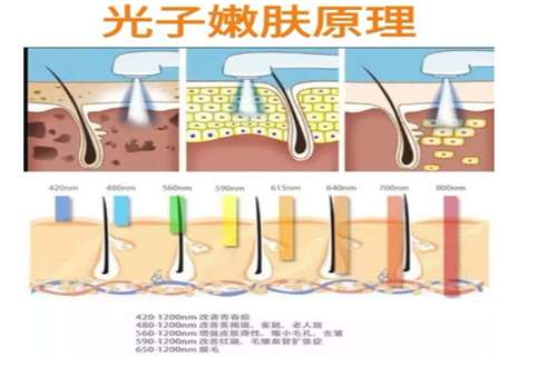 超光子嫩肤和水光针可以一起做吗？基本详情已经发表了