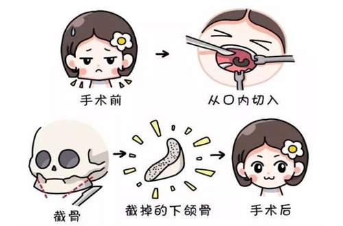 下颌角.jpg
