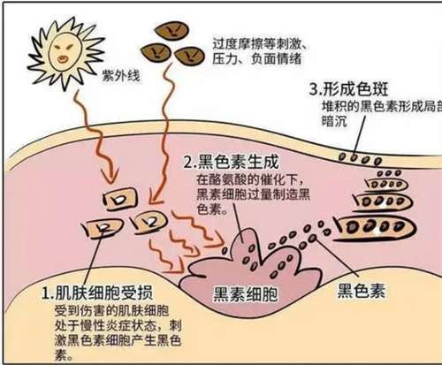超光子多久做一次效果好？注意事项及护理介绍