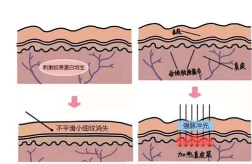 超光子全模式和光子嫩肤区别有哪些?多久做一次好?