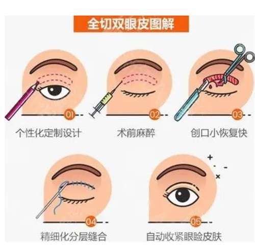 金奇龙双眼皮做得好吗？网友体验感反馈