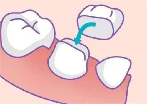 牙齿烤瓷费用怎么样？烤瓷牙齿能管多少年？
