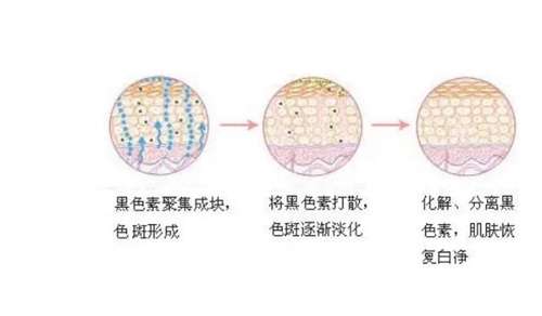 皮秒激光有什么效果?危害有哪些?