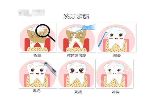 超声波洁牙3.jpg