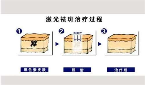 dpl精准光祛斑多少钱一次?祛斑需要做几次?