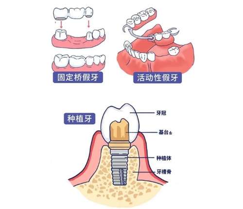 种植牙修复的周期是多久？修复后注意事项攻略