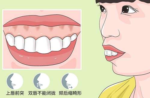 有点龅牙怎么办？龅牙矫正需要多长时间？