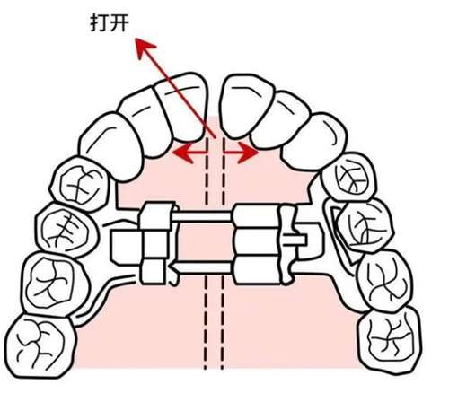 牙齿正畸可以用医保吗？正畸清洁步骤一览