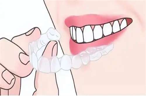 上海做牙套可以用医保吗？更多科普知识已经收集