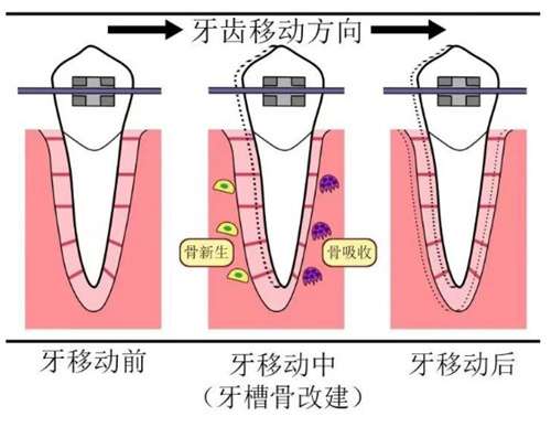 龅牙矫正后脸型变化图?龅牙矫正不拔牙可以吗