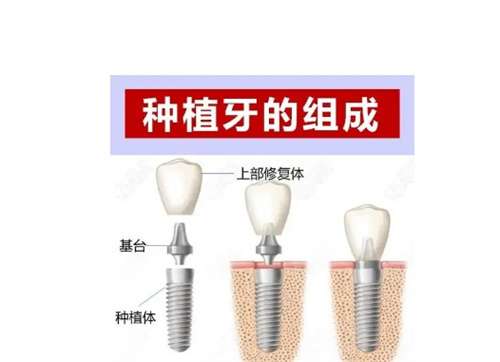 爱尔口腔医院种植牙价格？好评不断