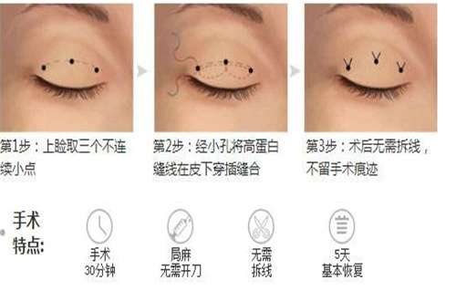 埋线2.jpg