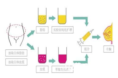 脂肪填充胸部可以维持多久？做胸的群众必看科普知识点