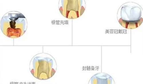假牙的种类及价格详细介绍?假牙后一般能维持几年?