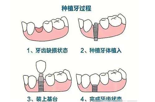 种植全口牙的钛支架是什么？作用呢？全面解析