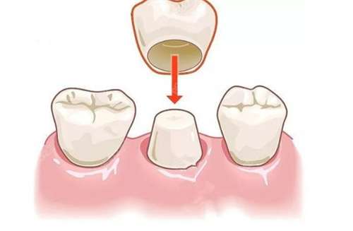 钛合金烤瓷牙的价格?钛合金烤瓷牙的优缺点?
