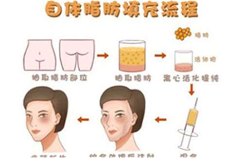 上海天佑医院脂肪填充怎么样?主打项目介绍