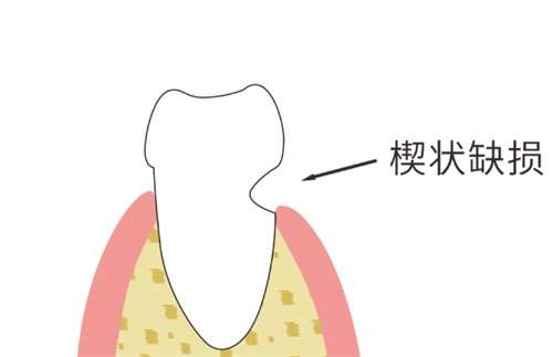 牙齿楔状缺损能自愈吗？牙齿楔状缺损需要补么？