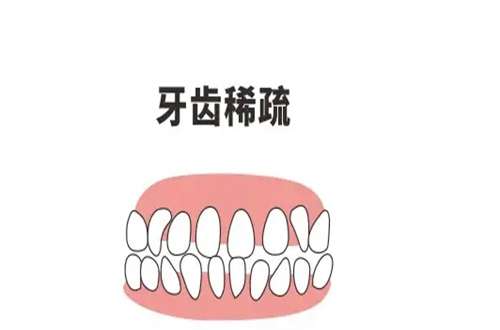 牙齿稀疏3.jpg
