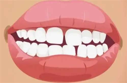 牙齿稀疏牙缝大什么原因？矫正中的那些疑问，这里解答
