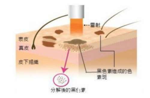 调q激光祛斑几天结痂脱落？调Q激光祛斑后多久可以洗脸？