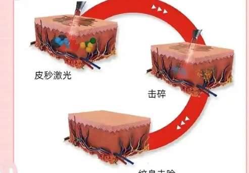 超皮秒洗纹身洗了9次会有副作用吗？超皮秒洗纹身会留疤吗？