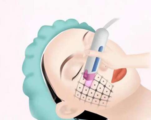 面部下垂好的提升方法有哪些？这些提升方法超有效