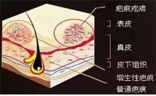 疤痕修复的佳方法？疤痕修复要多长时间？