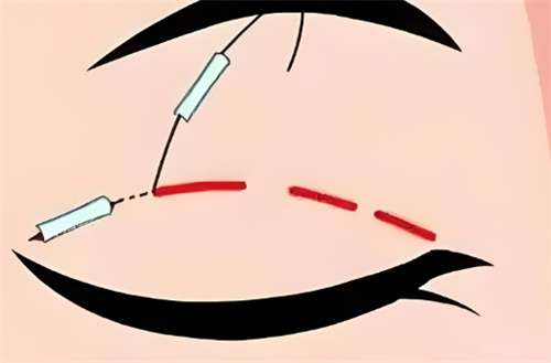 郑大二附院双眼皮怎么样?医院详情介绍