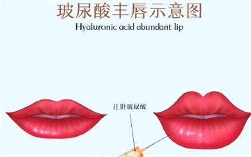 丰唇用什么玻尿酸比较好？丰唇一般能维持多久？