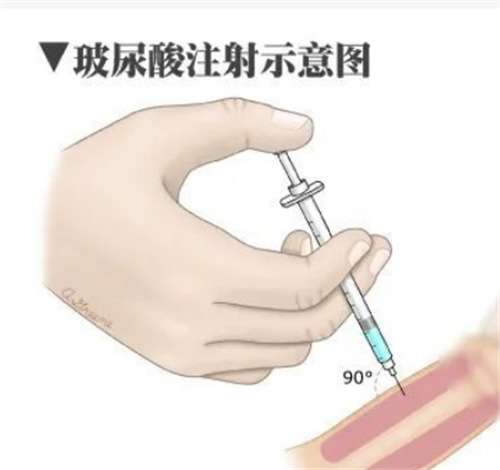男性打玻尿酸增大多少？相关的收费与危害已经整理