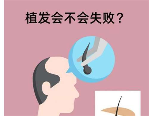 头发掉的太严重怎么解决？头发掉了植发有用吗？