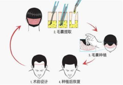头发种植多少钱一个毛囊？相关注意事项已经收集了