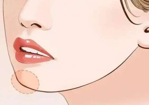 膨体垫下巴是永久的吗？膨体垫下巴会有什么后遗症吗？