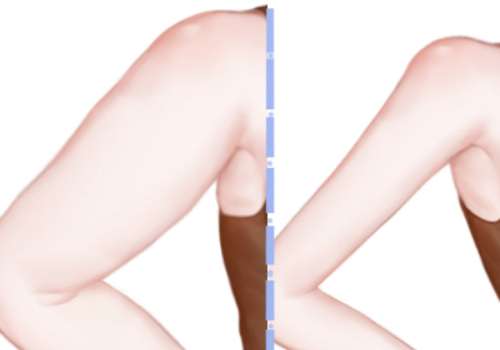吸脂瘦手臂有什么好处？弊端有哪些？术前术后需要注意什么？