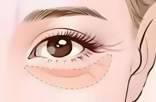 外路去眼袋手术后多少钱?不同城市不同方案差多少?看完不花冤枉钱