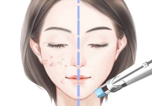 肤柔美胶原蛋白水光针有什么作用?适用人群、维持时间、术后护理等科普知识公开