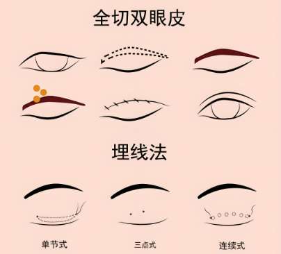 全国眼部整形医院排名如何？top名单在线看，曝光的都是靠谱名单