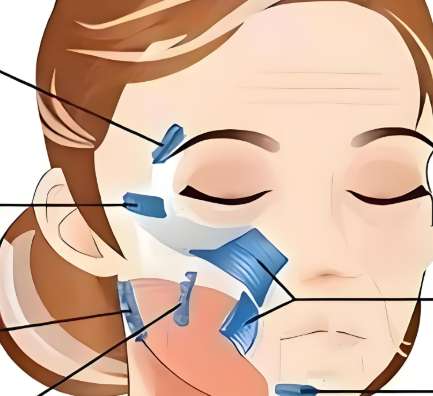 筋膜提升能维持多久？了解维持时间和术后护理一览查看