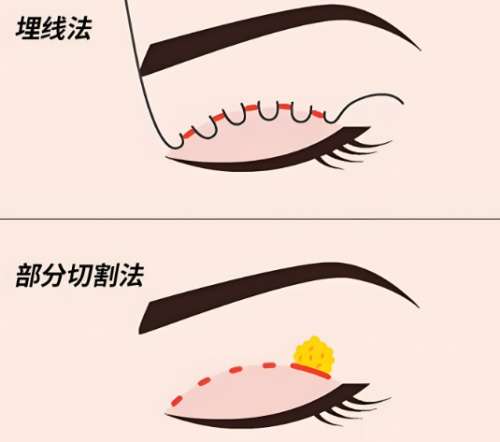 双眼皮手术.jpg