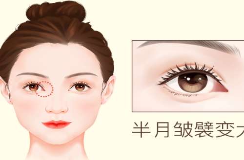 开眼角手术一般需要多少钱？开眼角手术的优势有哪些？
