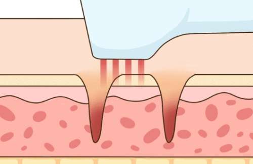 蚌埠祛斑前后对比图怎么样？黄褐斑点斑全消失，赶紧看