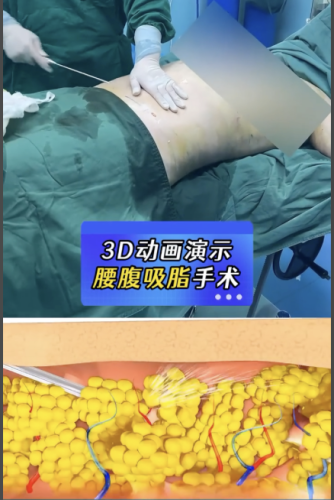 武汉腰腹环吸脂哪家医院好?今天好好扒一扒!