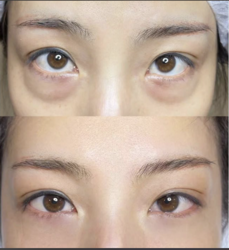 重庆做祛眼袋手术在哪个医院好?全市深入打探一番