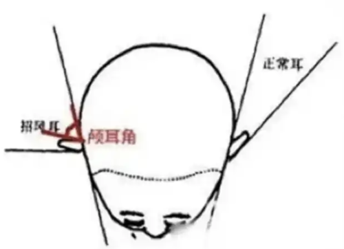 颅耳角可以调节吗？重塑攻略来支招