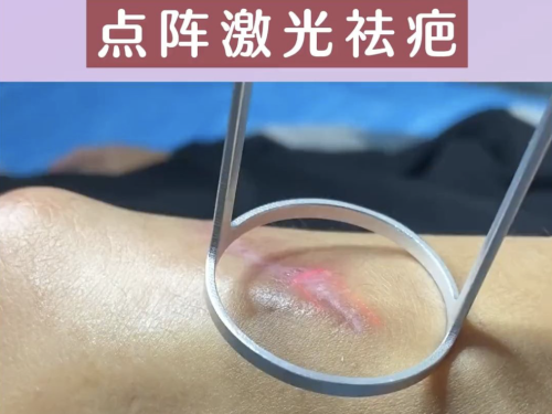 广州曙光医院去疤痕效果好吗？实测疤痕 “橡皮擦” 是真是假？