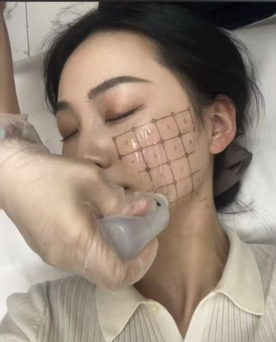 热玛吉做一次能维持多久？效果续航大揭秘