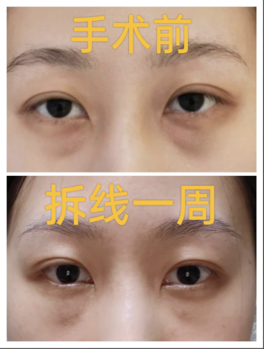 北京哪里做眼袋比较好的医院?优质医院大盘点
