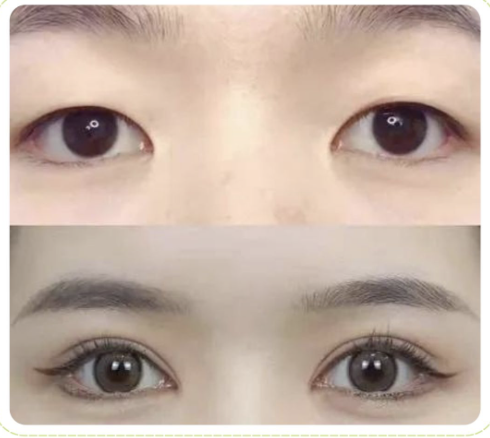 苏州哪家整形医院做双眼皮好？热门医院大测评